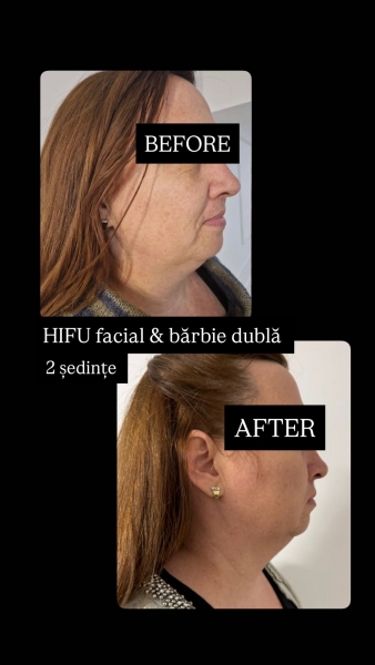 Hifu facial barbie dubla Bucuresti