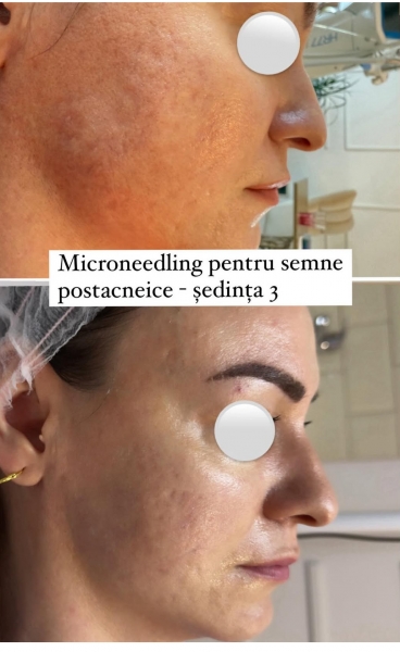 Microneedling București: Adio cicatrici! Rezultat vizibil după 3 ședințe la Skin Medica.