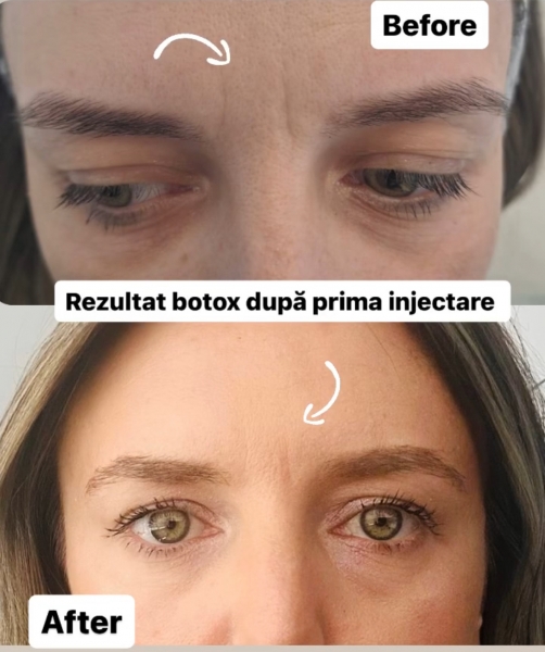 Botox București: Riduri netezite, aspect întinerit după o singură injectare!