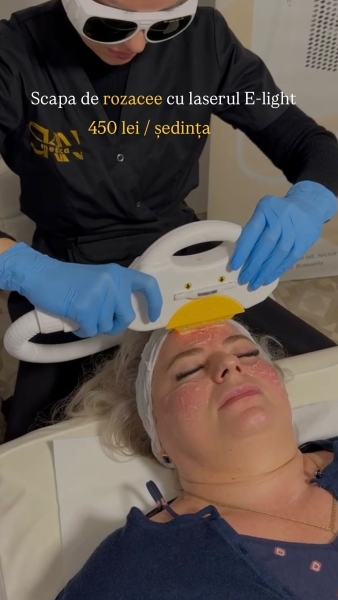 Pacientă urmând tratament pentru rozacee cu laser E-light la clinica Skin Medica București.”